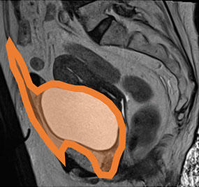 MRI of Endometriosis - RAD-ASSIST