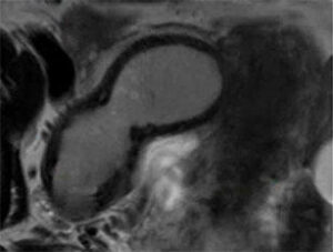 MRI Of Endometriosis - RAD-ASSIST