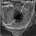 MRI Rectal Cancer Staging - RAD-ASSIST