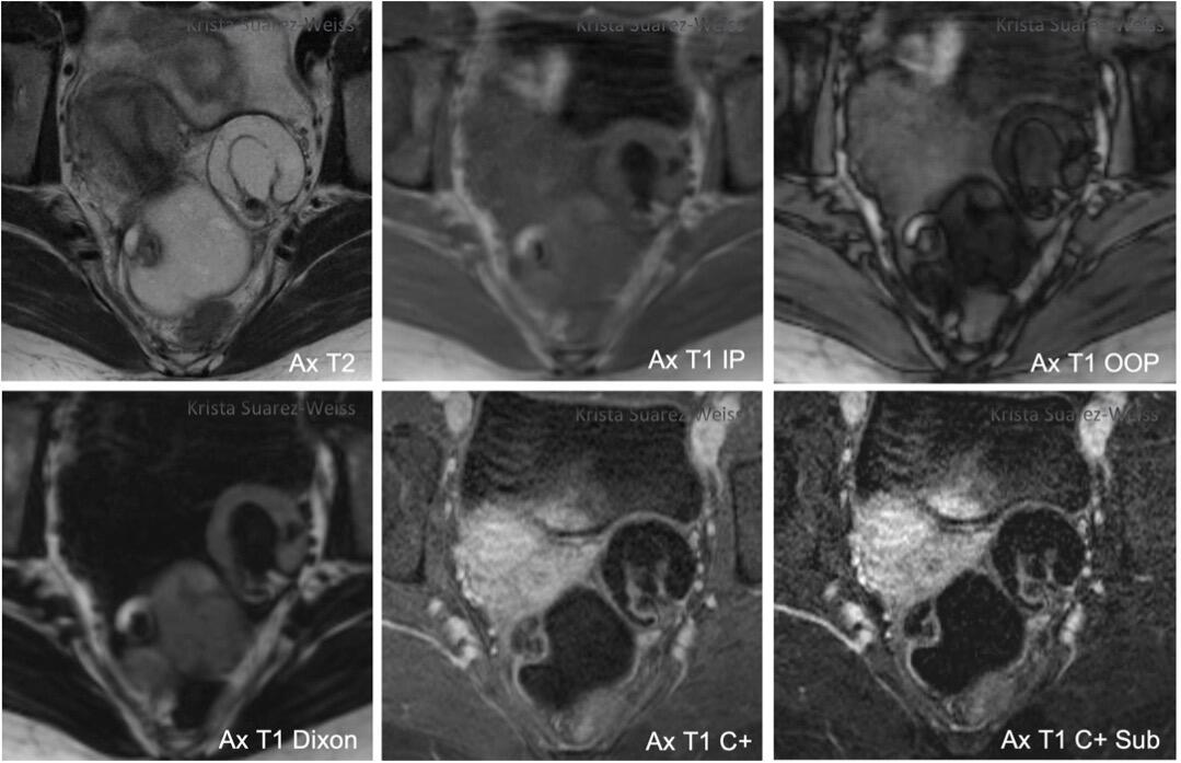 O Rads Example Mri Adnexal Lesions: O-RADS MRI - RAD-ASSIST