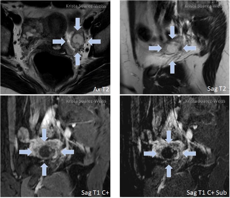 O Rads Example Mri Adnexal Lesions: O-RADS MRI - RAD-ASSIST