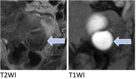 Adnexal Lesions: O-RADS MRI - RAD-ASSIST