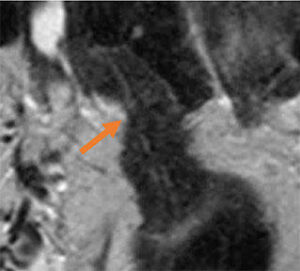 MRI Of Endometriosis - RAD-ASSIST