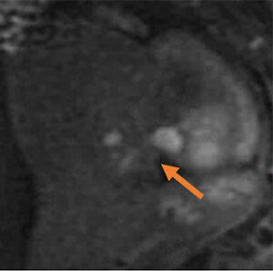 Mri Of Endometriosis Rad Assist