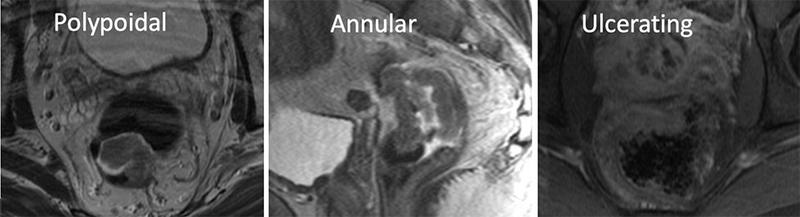 MRI Rectal Cancer Staging - RAD-ASSIST