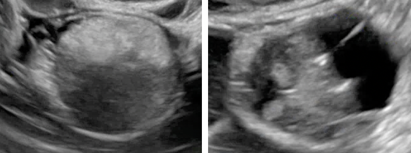 Adnexal Lesions: O-RADS US - RAD-ASSIST